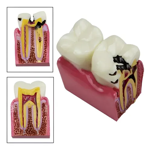 modelo de patología dental